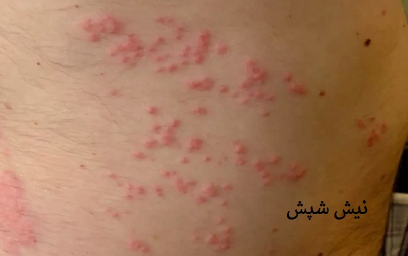 نیش شپش